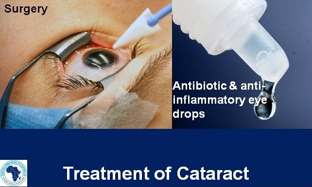 Treatment of cataract